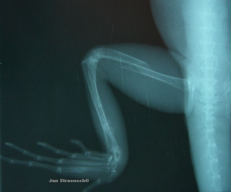 Rntgenbild eines Beinbruchs